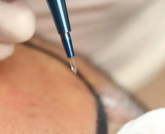 sapphire fue hair transplant banner