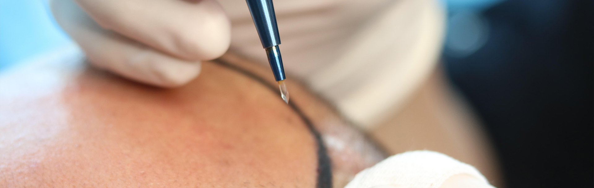 Sapphire FUE Hair Transplant - Hairpol