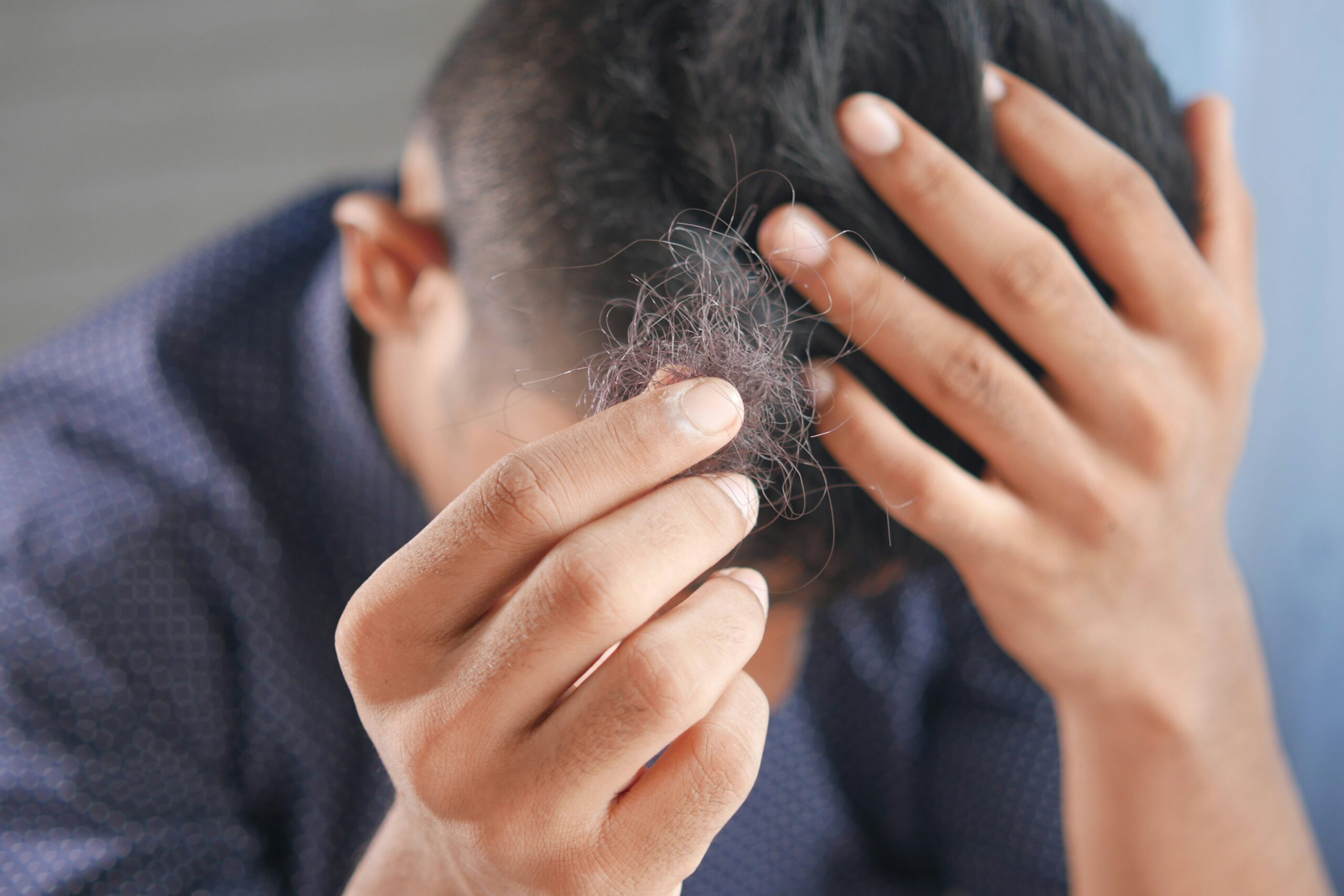 What Happens If You Don’t Do a Hair Transplant? Understanding Long-Term Hair Loss