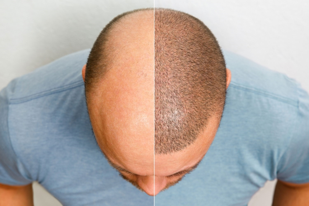 Why Transplanted Hair Falls Out Before It Grows Back