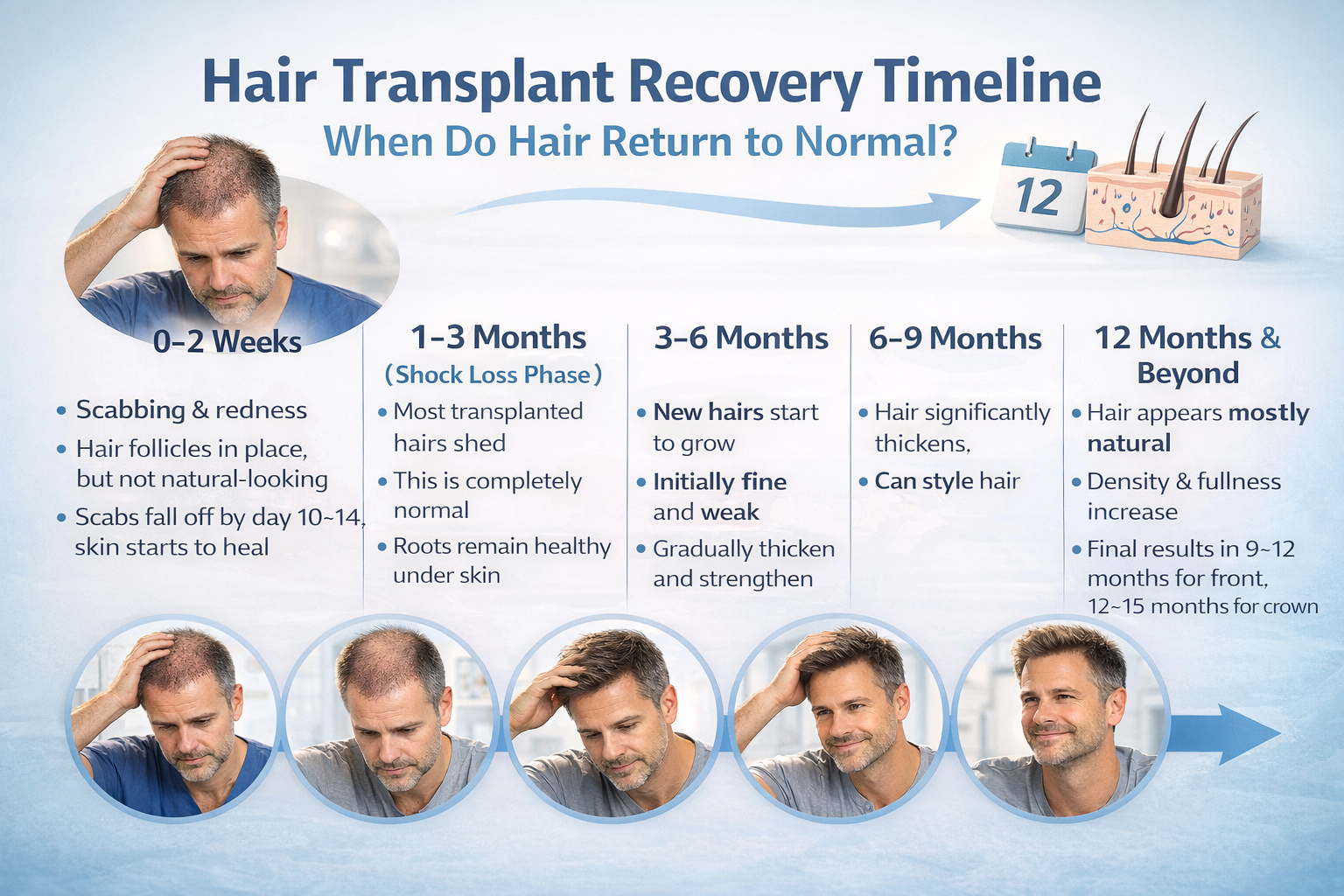 Hair Transplant Recovery Timeline - When Do Hair Return to Normal?