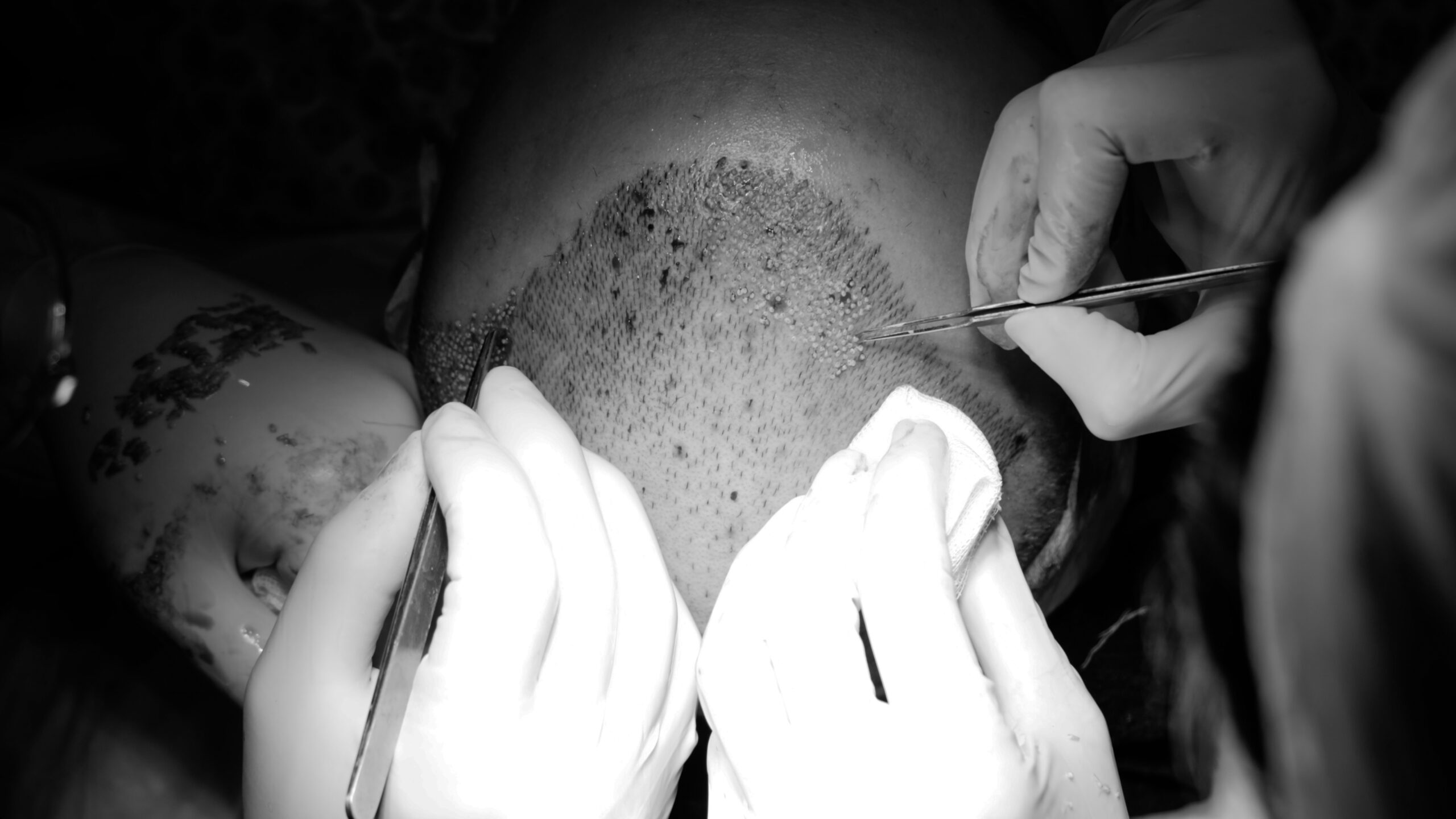 How Many Grafts Do You Actually Need for a Natural Result?