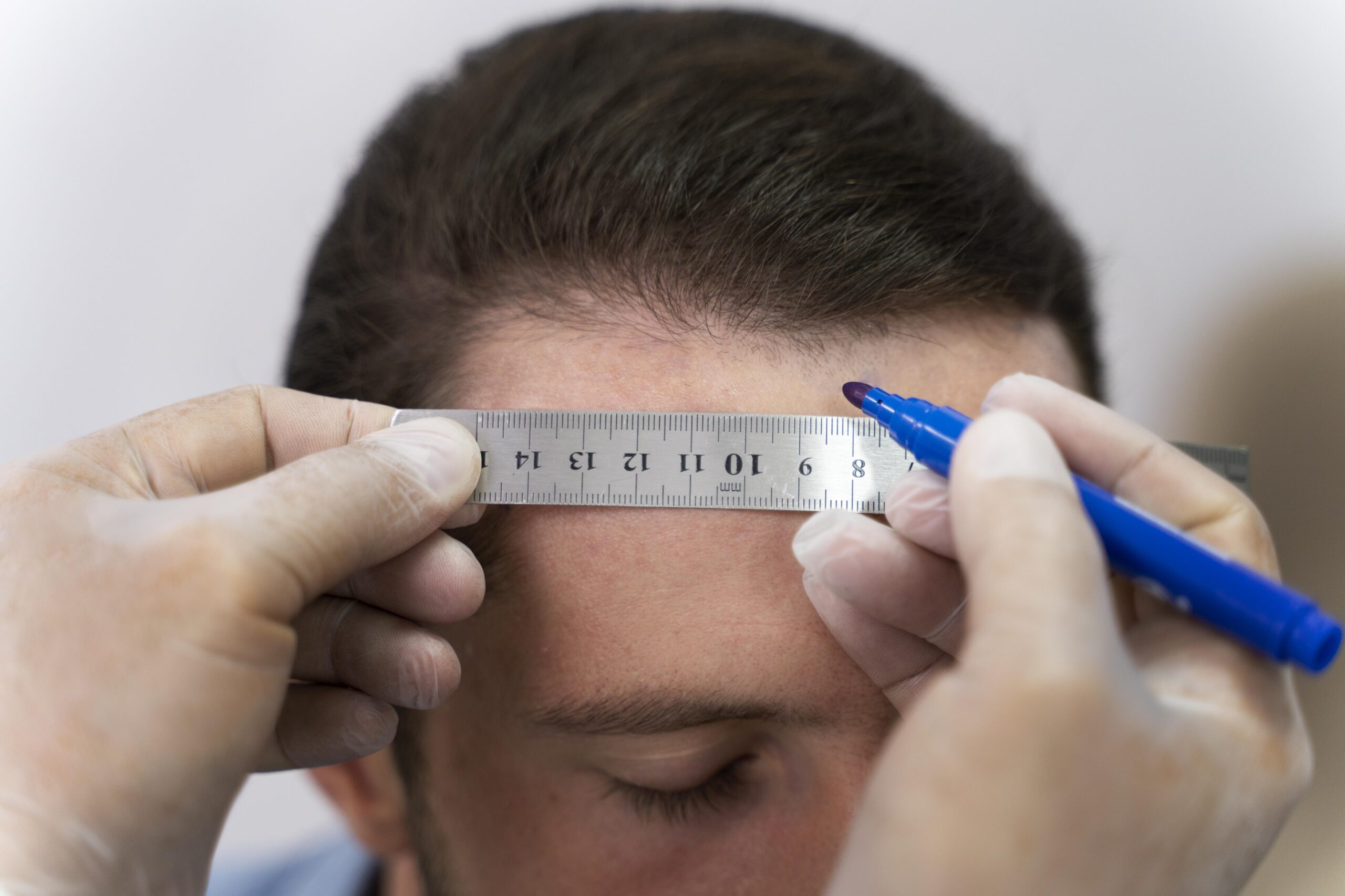 Hair Transplant for a Receding Hairline: What Results Are Realistic?