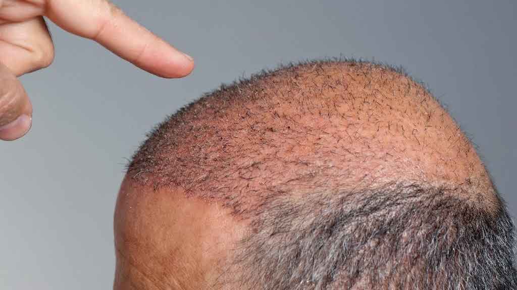 What Causes Shock Loss After a Hair Transplant and How Long Does It Last?