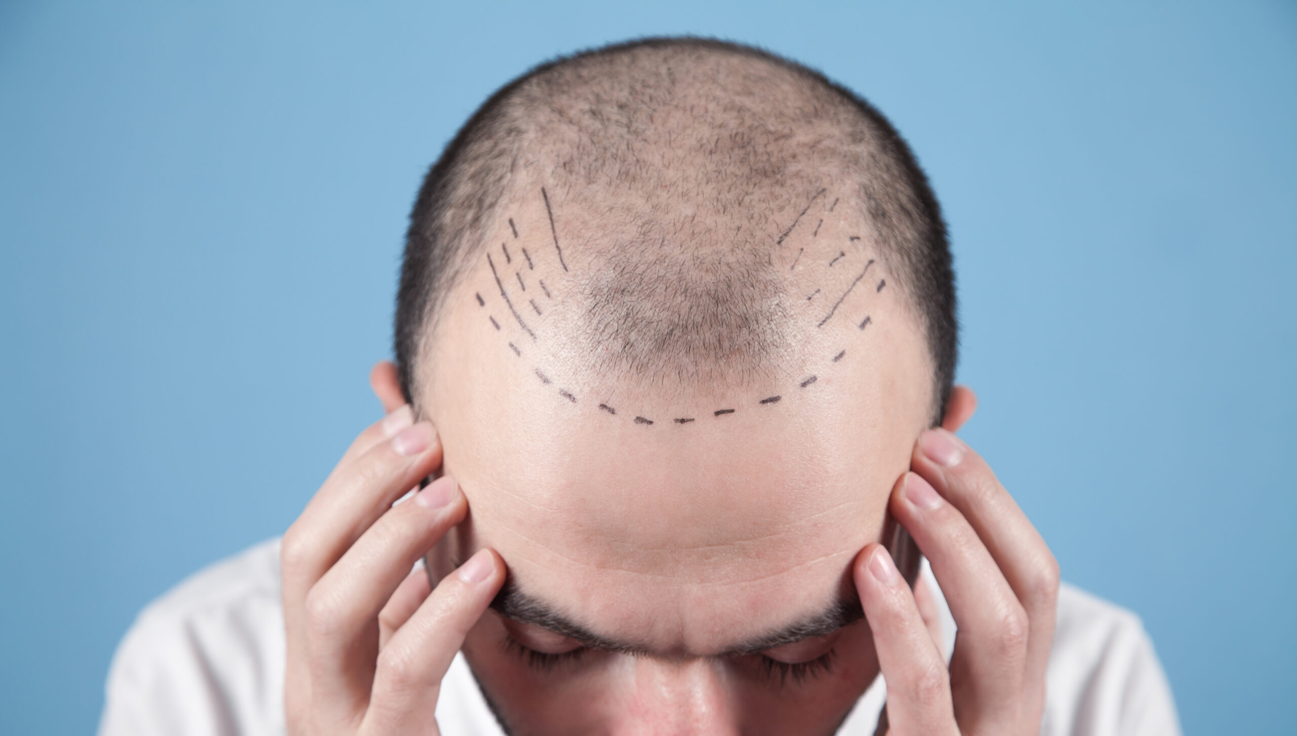 Hair Transplant Turkey vs Europe: What's the Real Difference in Quality and Price?