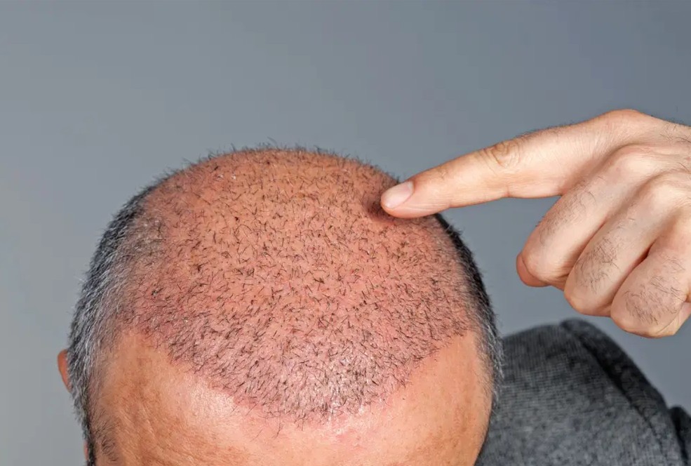Why Does Hair Transplant Density Look Thin in the First Months?
