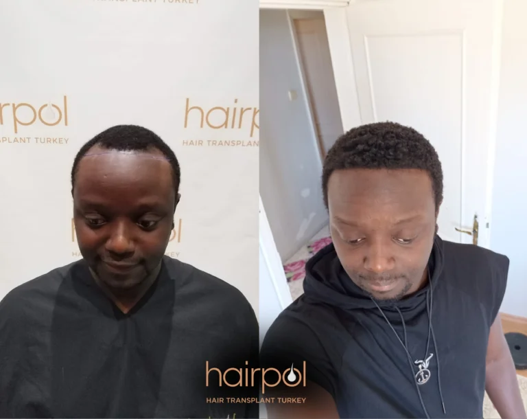 6,000 Grafts FUE Hair Transplant — Maximum Session, 12 Month Result