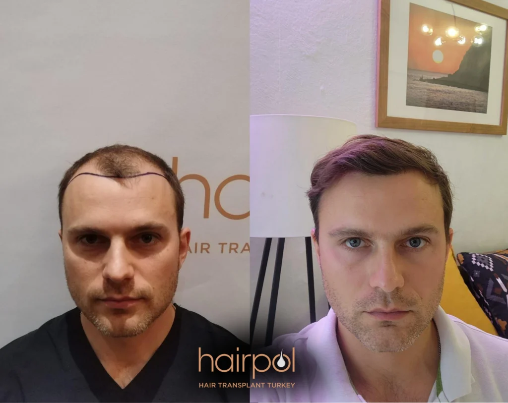 FUE technique 5000 graft hair transplant before after