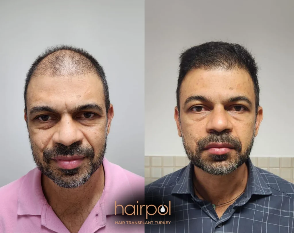 DHI technique 3500 graft hair transplant before after