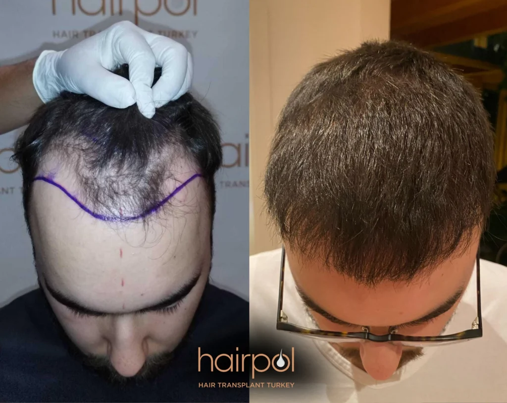 FUE technique 4500 graft hair transplant before after