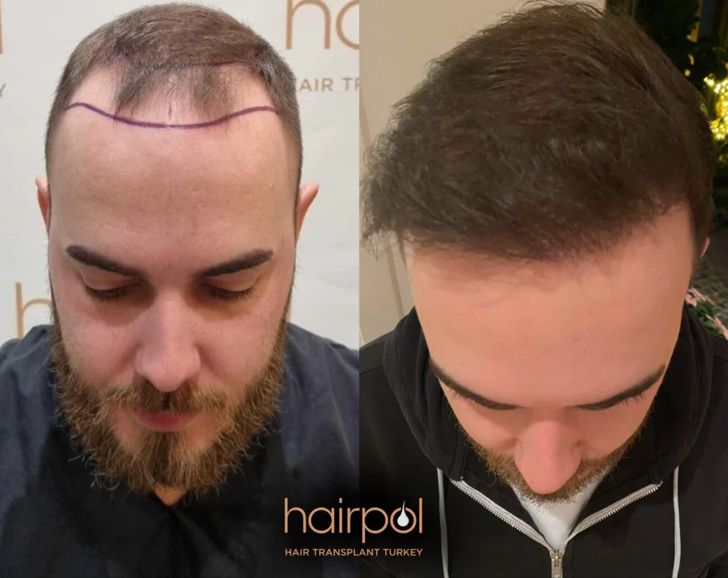 FUE technique 5000 graft hair transplant before after