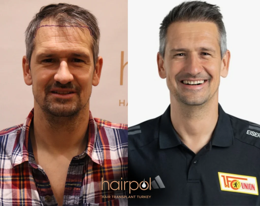 FUE technique 4000 graft hair transplant before after