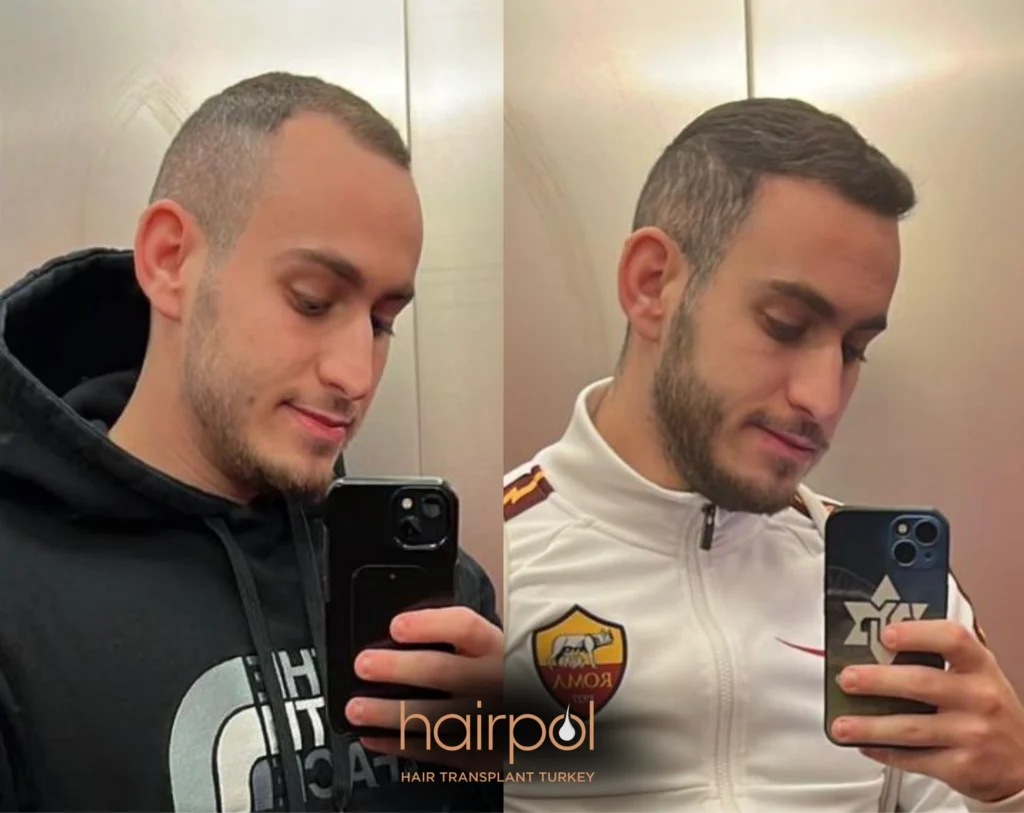 DHI technique 3000 graft hair transplant before after