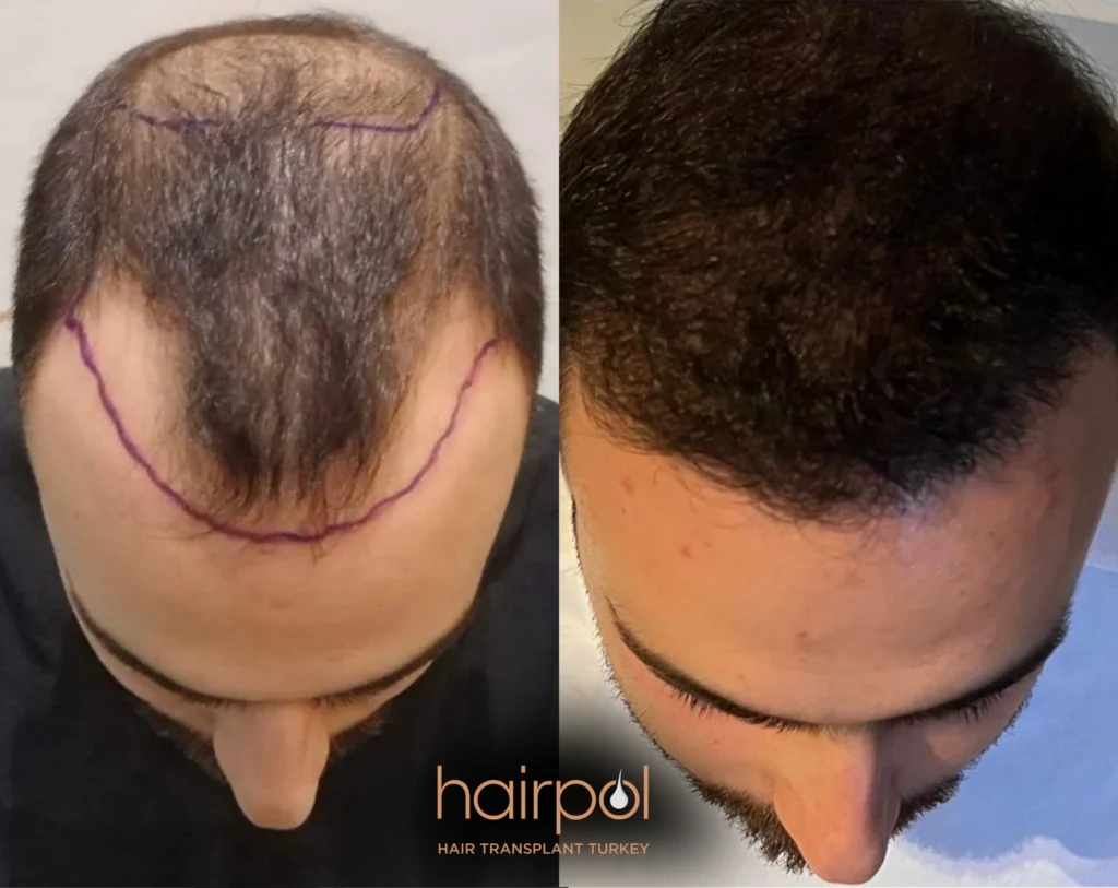 DHI technique 5000 graft hair transplant before after
