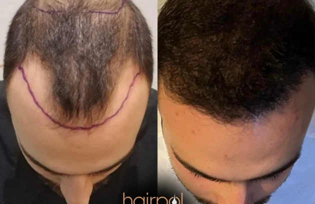 5,000 grafts DHI hair transplant, full restoration in one session