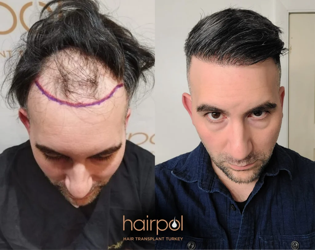FUE technique 4000 graft hair transplant before after