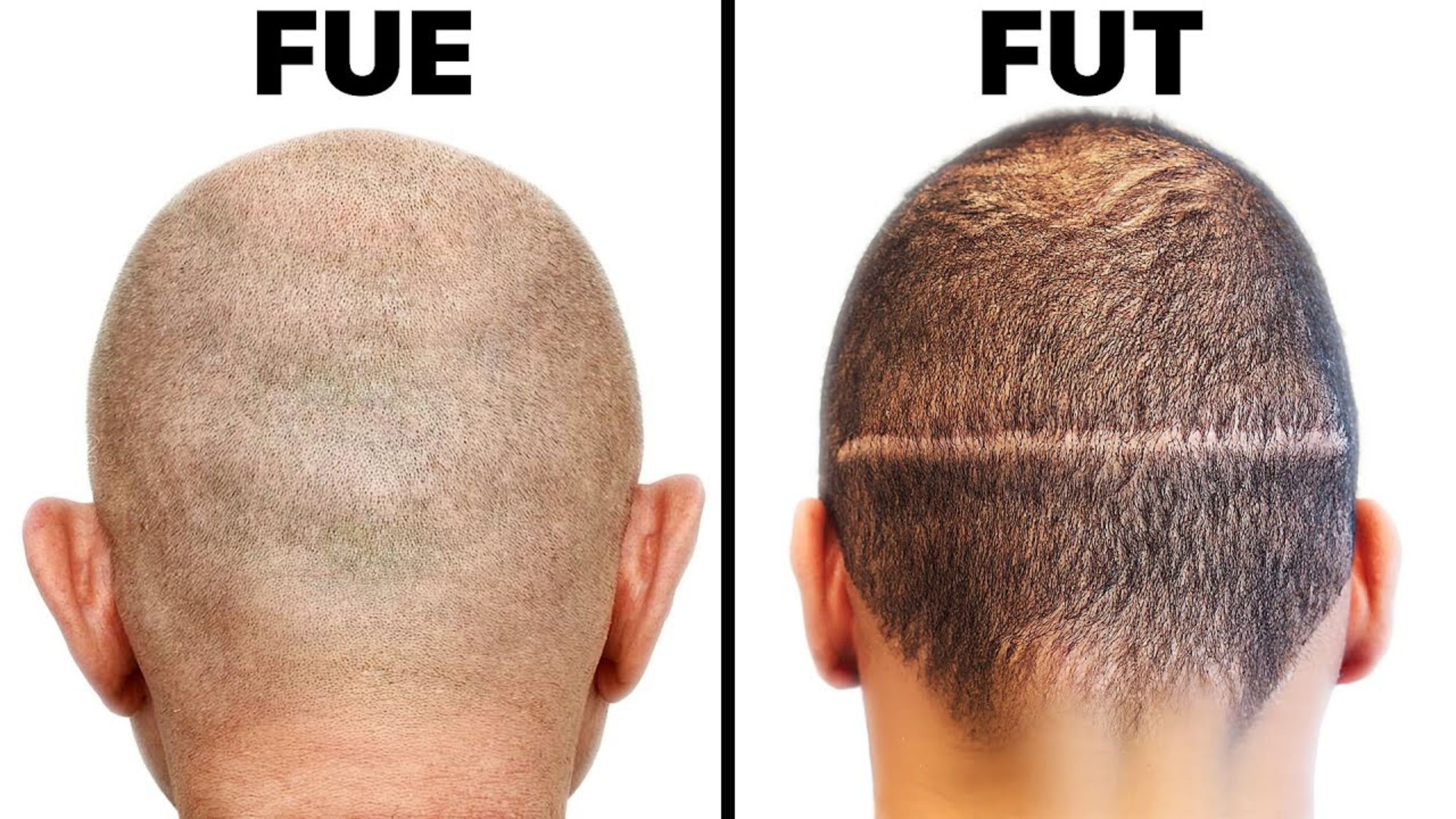 What Is the Difference Between FUT and FUE Hair Transplant?