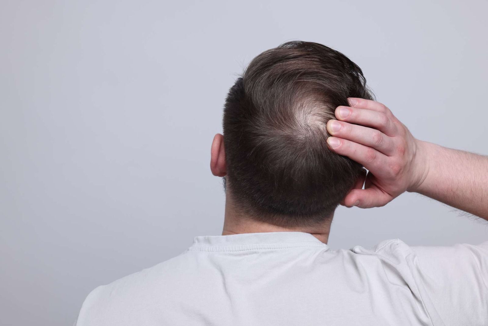 Crown hair transplant planning with graft count assessment