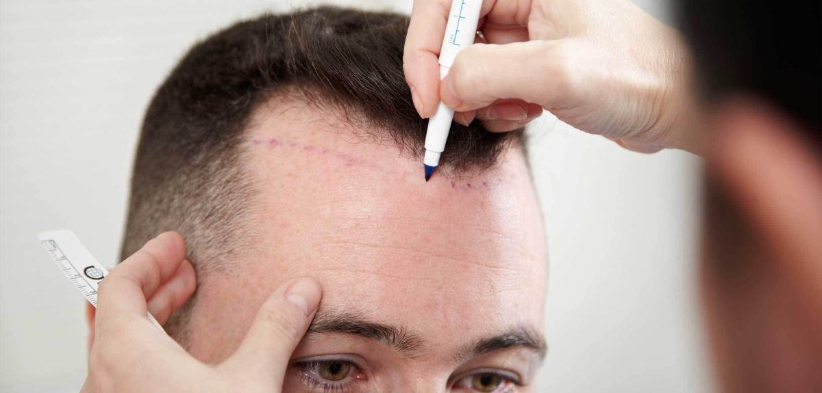 What Is a Hairline Design Consultation and Why Does It Matter?