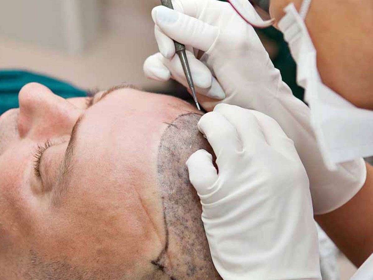 Hair Transplant Results After 5 Years: What Does the Result Look Like Long-Term?