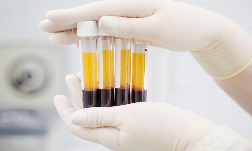 PRP Therapy After Hair Transplant: Does It Actually Help Growth?