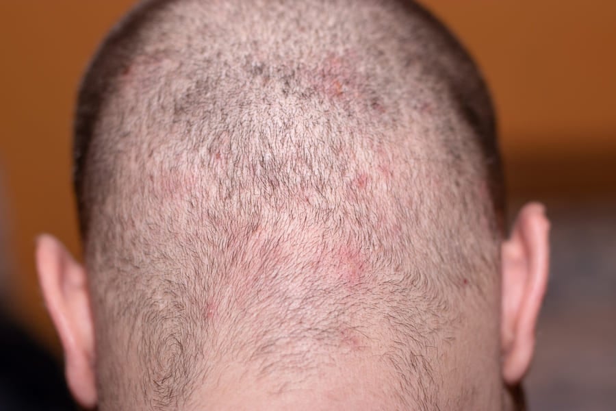 Is Hair Transplant Safe — What Are the Real Risks?