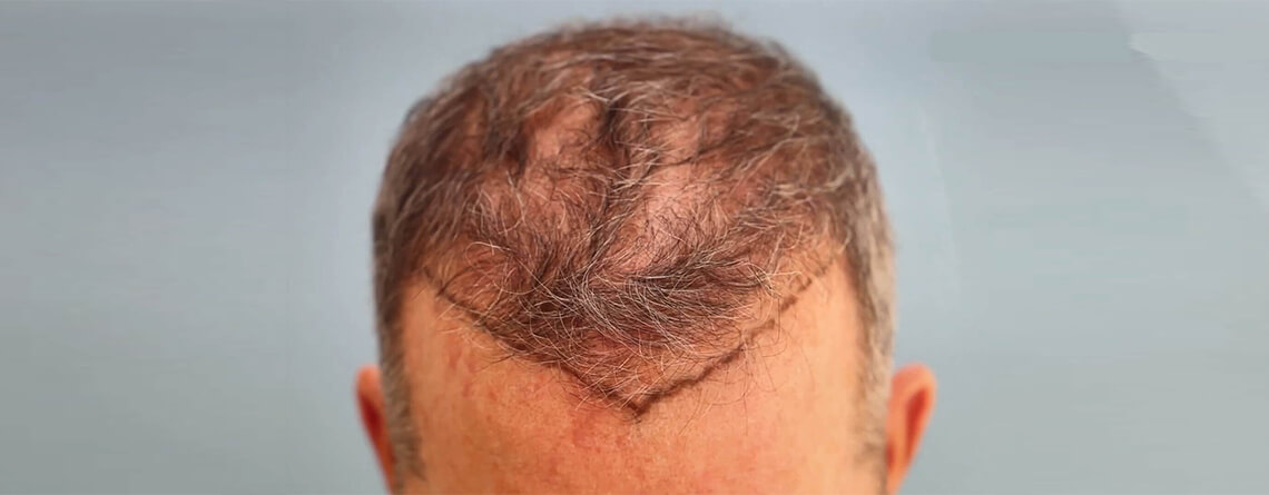 Can a Second Hair Transplant Damage the First One?