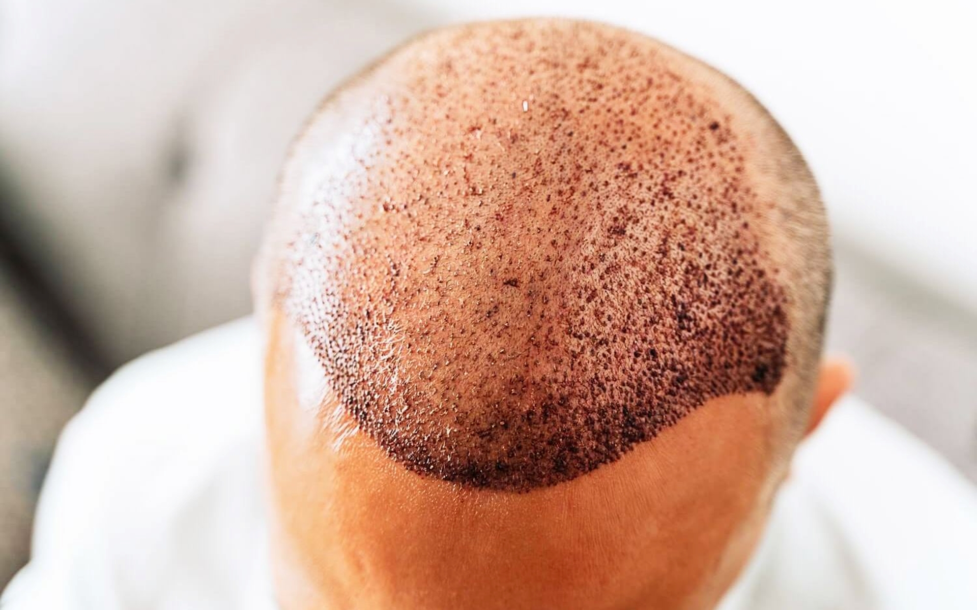 What Happens If You Don't Follow Aftercare Instructions After a Hair Transplant?