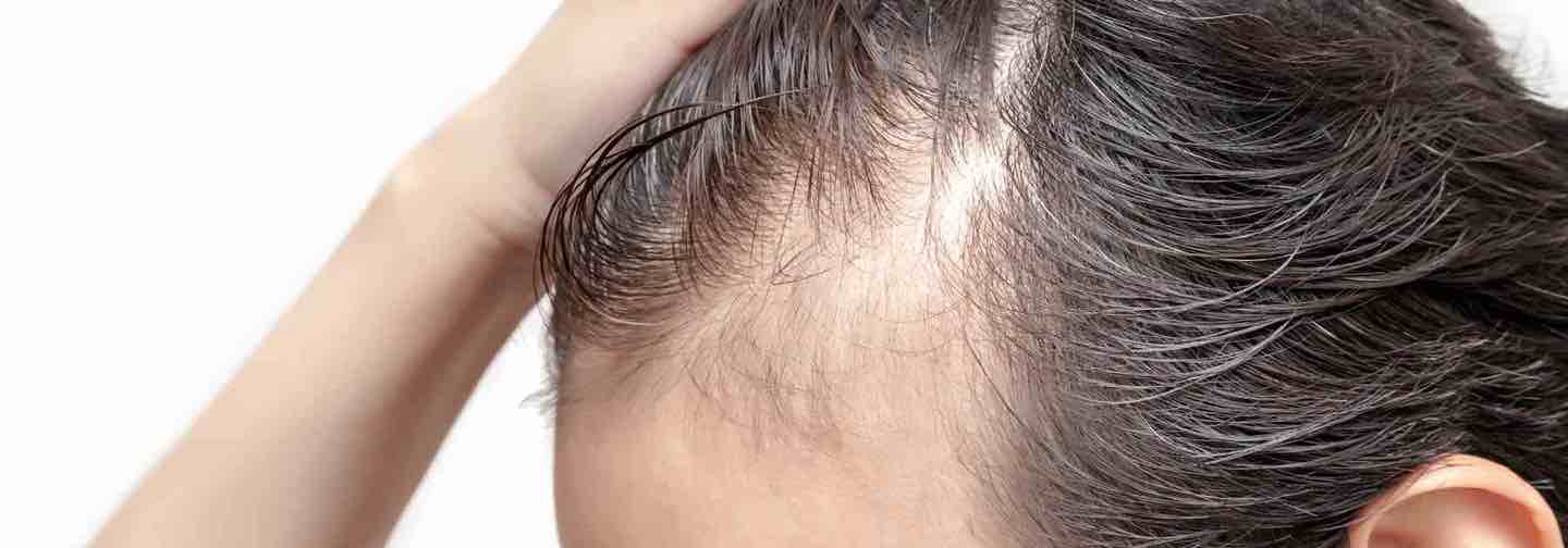 How Stress Affects Hair Transplant Recovery and Results