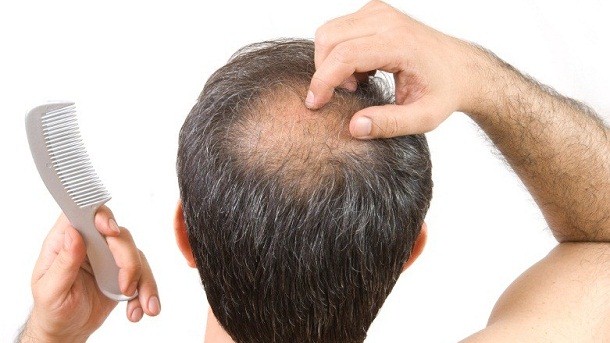 Hair Transplant for Thinning Hair: Is It the Right Solution?