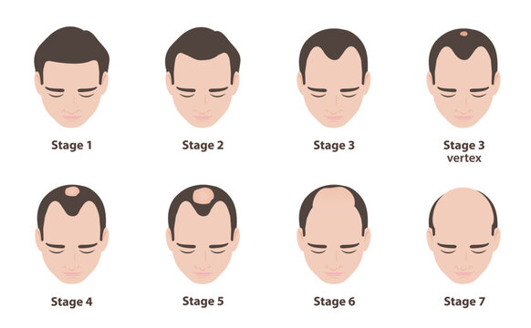 Norwood scale stages chart showing male pattern hair loss progression