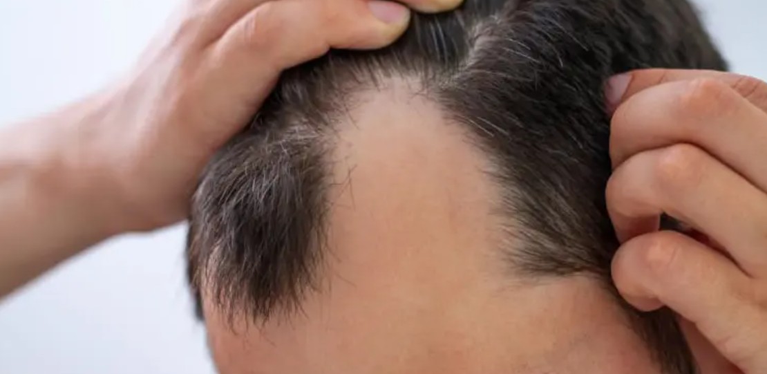 Diffuse thinning compared with pattern baldness on the scalp