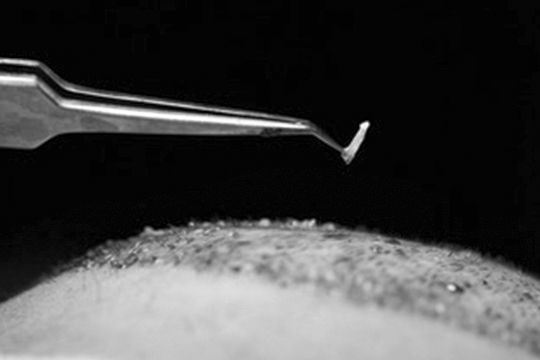 Ergebnis von Scalp Micropigmentation im Vergleich zu einer Haartransplantation