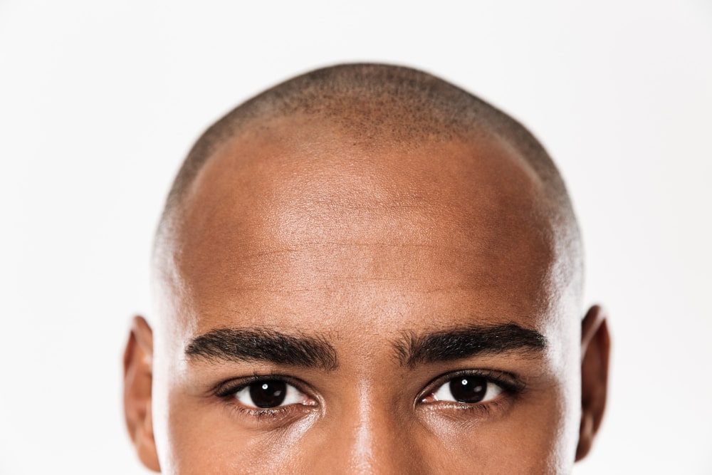 Afro hair transplant planning for type 4 coily hair at Hairpol