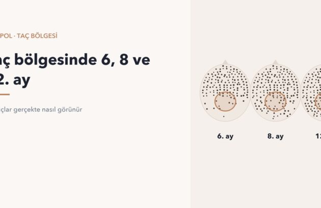 Saç ekiminden 6, 8 ve 12 ay sonra taç bölgesi yoğunluğu