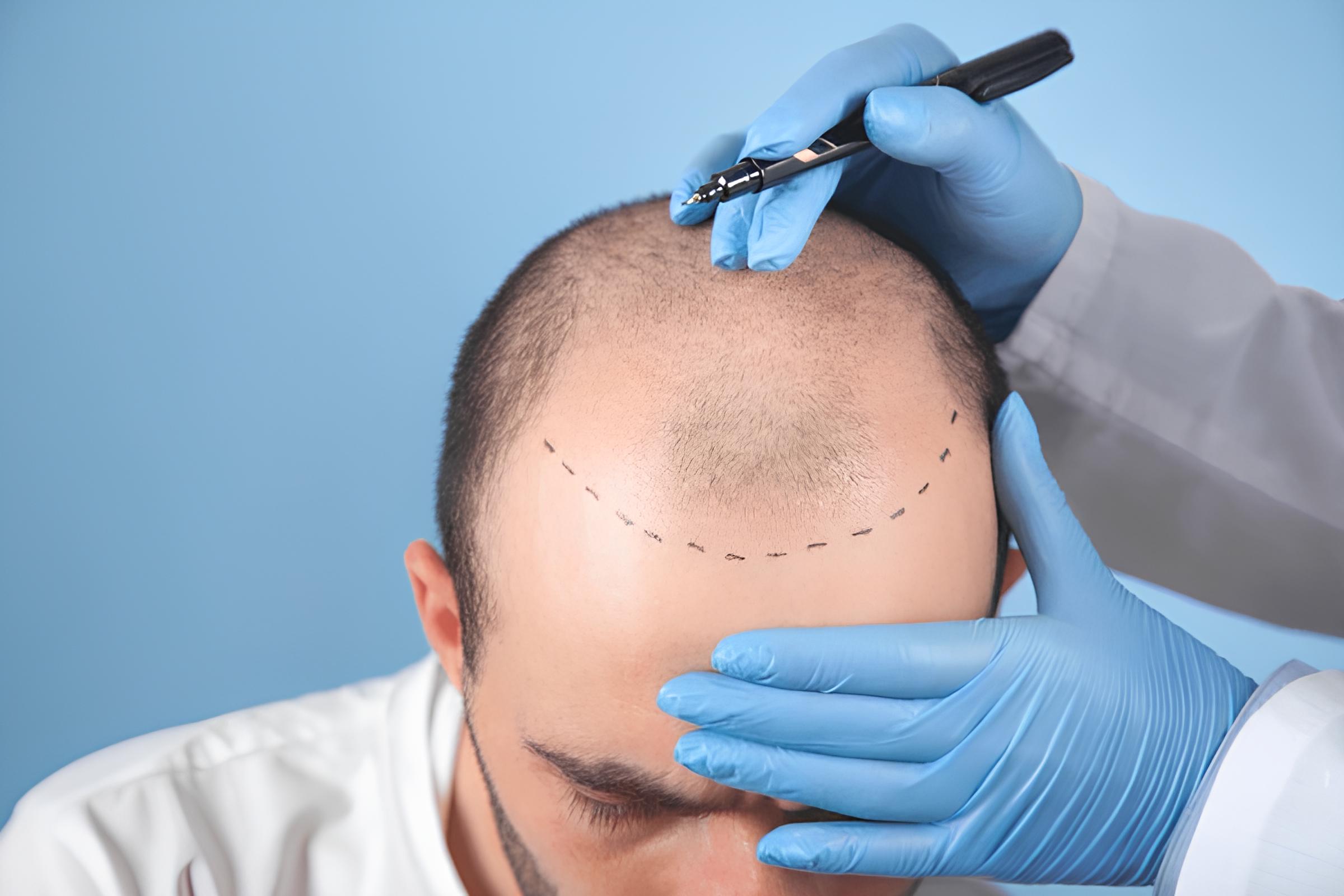 Honest hair transplant consultation at Hairpol discussing realistic limits and alternatives