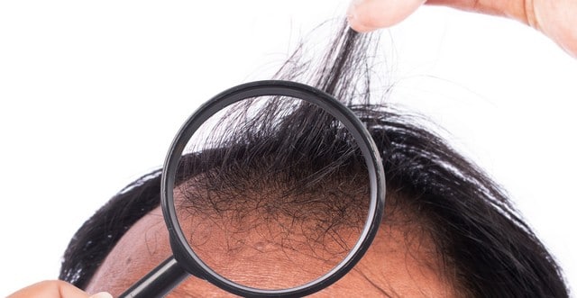 How DHT binds to follicles and drives hereditary hair loss