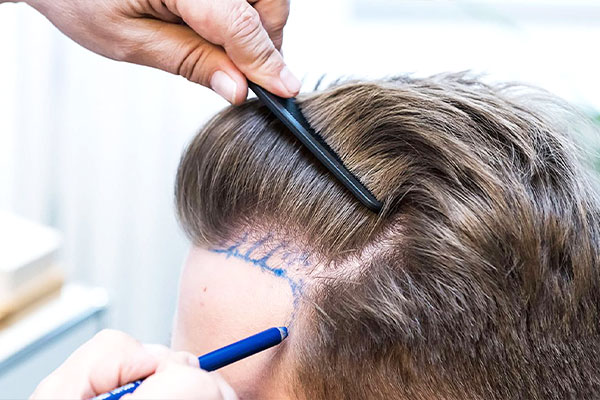 Natürliche, unauffällige Haarlinie nach einer korrigierenden Haartransplantation