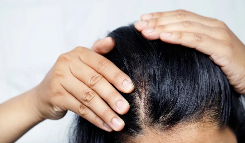 Traction alopecia at the hairline and temples in a female patient before hair transplant assessment