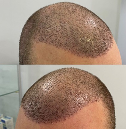 Scalp around day ten after a hair transplant with crusts cleared