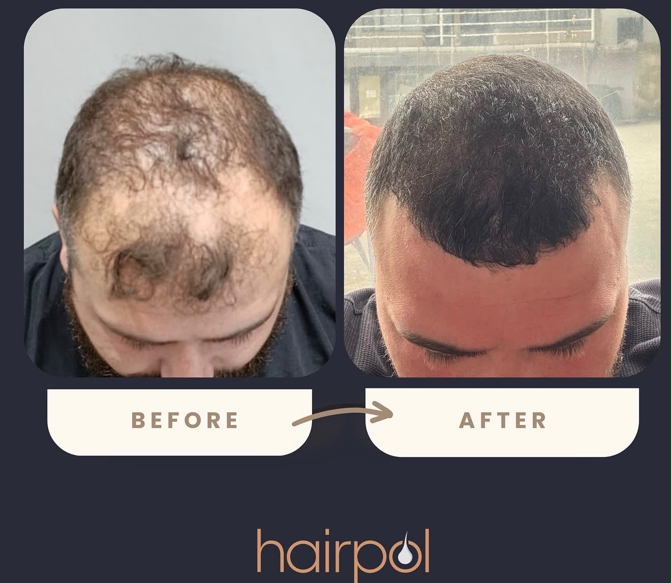 Twelve-month FUE result showing thicker, darker hair covering the scalp