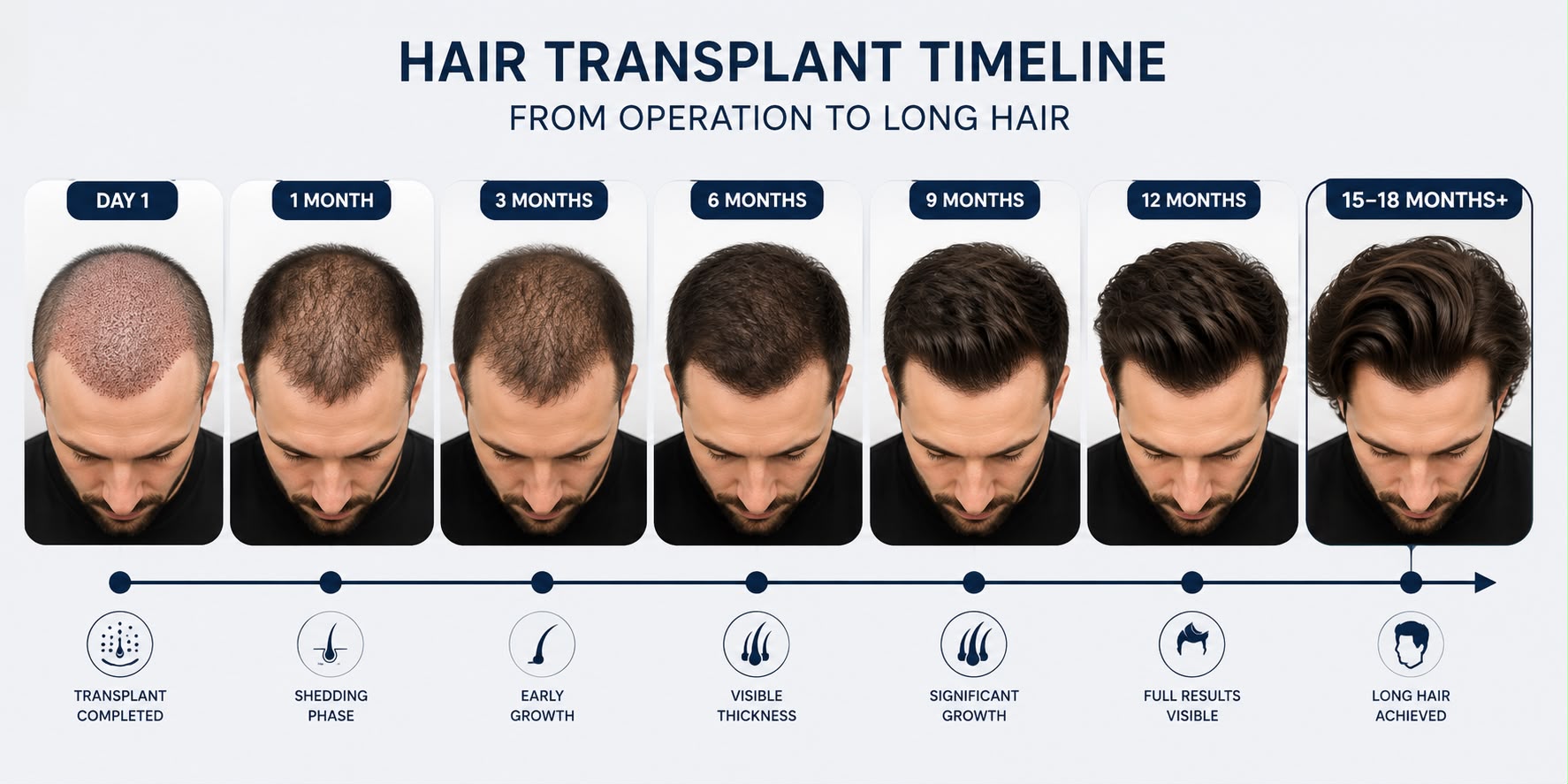 Patient with grown-out hair one year after a hair transplant