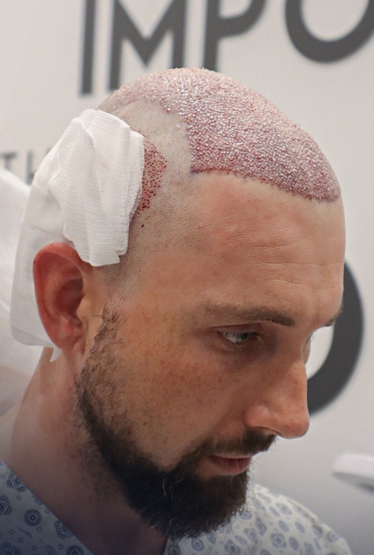 Recipient area healing in the first days after a hair transplant