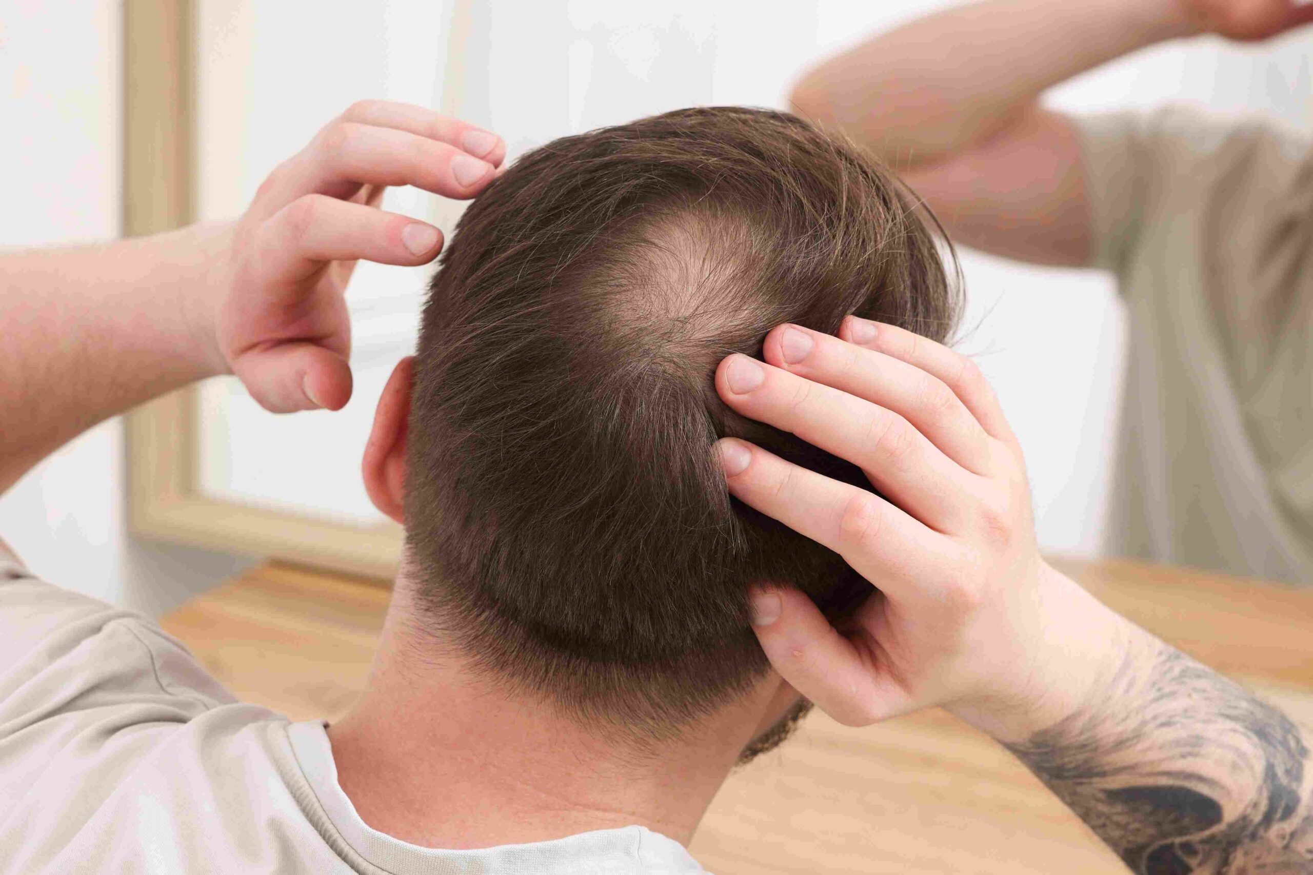 Crown area of a hair transplant patient with scalp still visible through sparse coverage