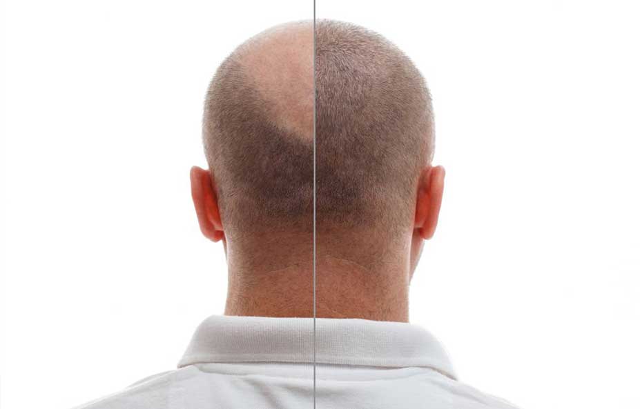 Close-up of crown regrowth with short dark hairs emerging around month eight