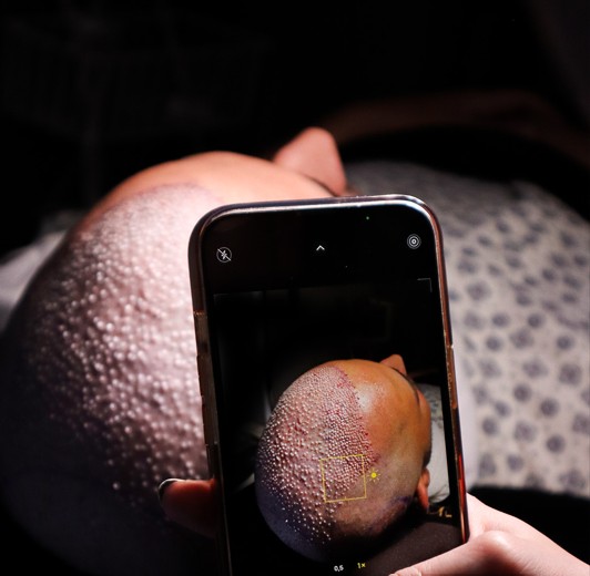 FUE hair transplant result photographed from the front after full growth