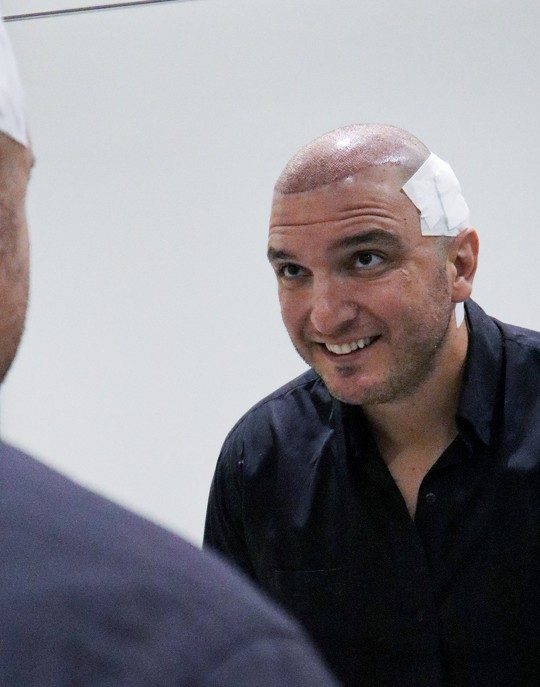 Shiny recipient area on the scalp in the weeks after hair transplant surgery