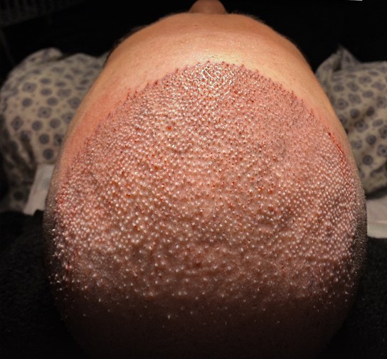 Pink glossy scalp skin photographed shortly after the crusts came off