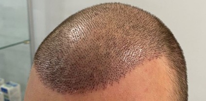Scalp shine fading as early regrowth begins to break up the reflection