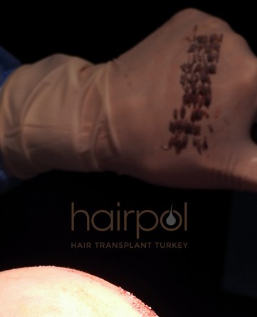 Extracted follicular unit grafts lined up on a gloved hand during surgery